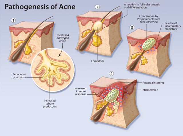 0704acne_patho_horiz.png