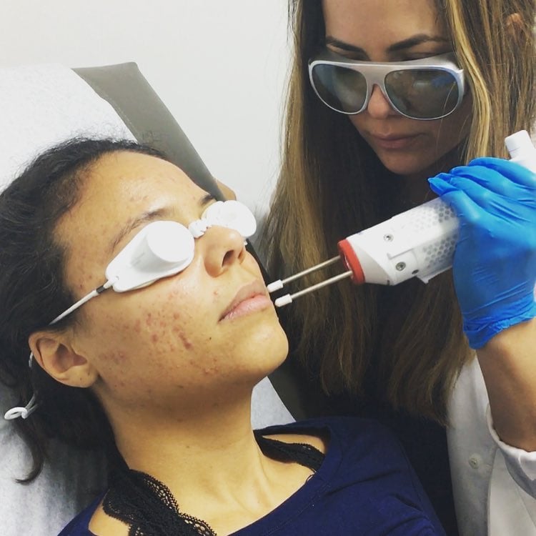 Acne Laser Treatment A Fresh Approach to Treating Your Acne