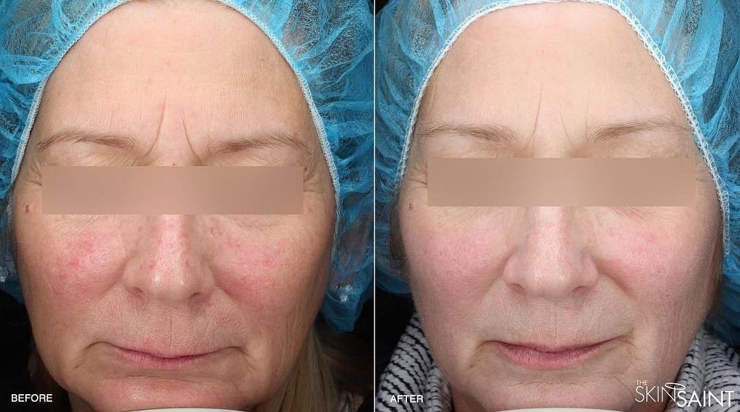 neoskin by aerolase comprehensive rejuvenation by holly cutler the skin saint