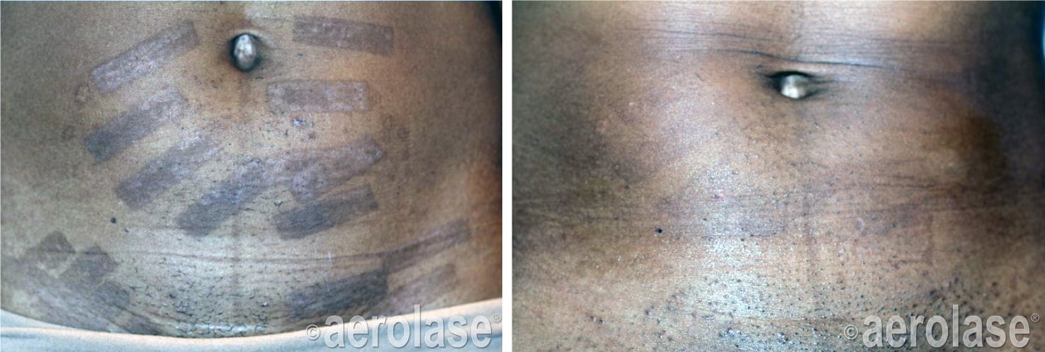 Burns - IPL - Cheryl Burgess - After 2 Tx