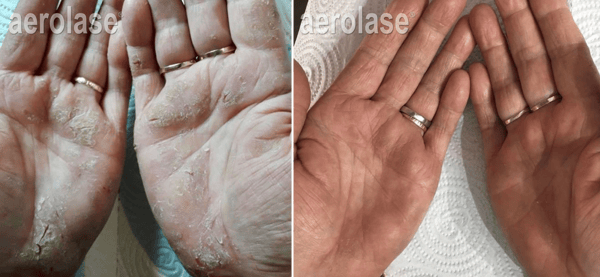 treating psoriasis with laser after two treatments
