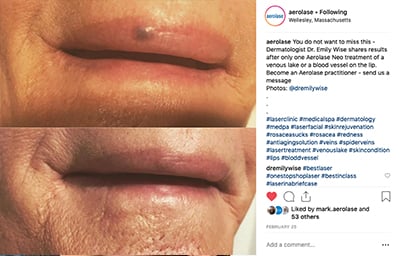 emily wise aerolase wellesly massachusetts dermatology