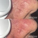 Spider veins can be diminished on the same day as initial treatment Results are taken five minutes posttreatment Incredible results may vary aerolase neoskinbyaerolasePhotos skinmadesimple westdermcenter