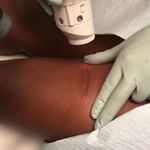 Dr Cheryl Burgess is using a combination therapy of Aerolase Neo Microsecond laser technology and fraxelus to remove vascularity and other pigmentation from this existing scar on her patients leg to make it less noticeable aerolaseVideo ctrdermatology